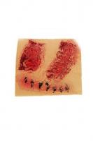 Рана с черным швом